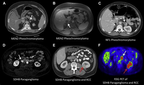 The Genetic Basis Of Pheochromocytoma And Paraganglioma Implications