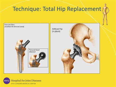Ppt Arthritis Of The Hip Powerpoint Presentation Free Download Id