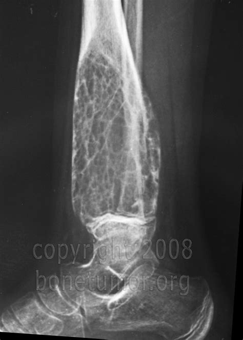 Aneurysmal Bone Cyst Foot And Ankle