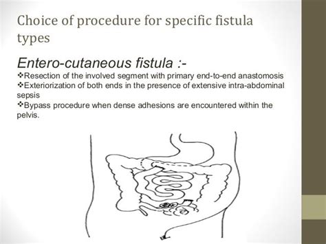 Enterocutaneous Fistulas