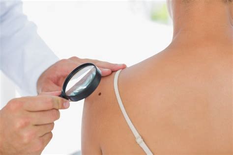 11 Moles On Your Arm May Signal Higher Melanoma Risk Live Science