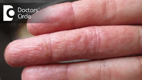 Eczema Dermatitis On Fingers Atopic Dermatitis Symptoms