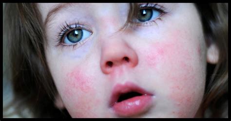 Scarlet Fever Is Making A Comeback Here Are The Warning Signs