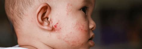 Is It Baby Acne Or Eczema Yoro Naturals