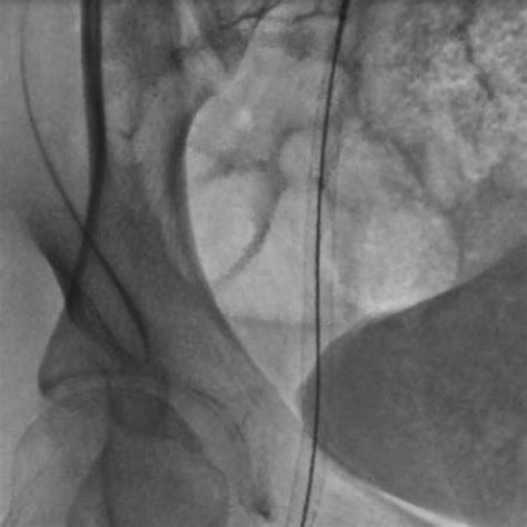 The Image Depicts The Stenting Of The Iliac Artery To The Common