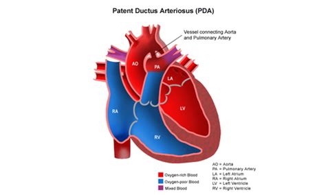 Difference Between Pfo And Pda Difference Between