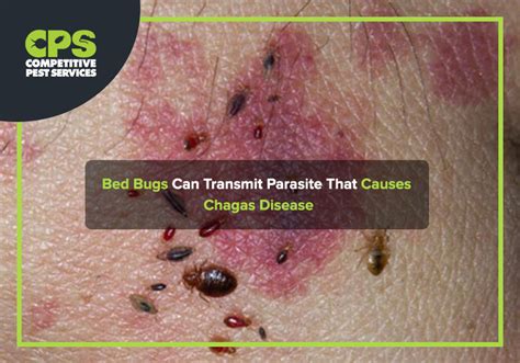 Bed Bugs Can Transmit Parasite That Causes Chagas Disease