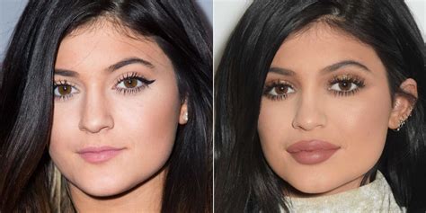18 Facts About Lip Injections What You Should Know About Lip Augmentation