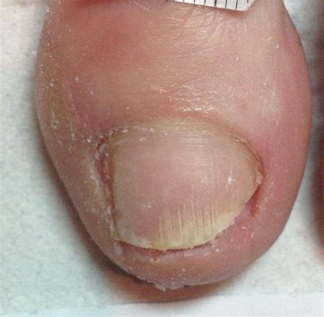 4 Signs You Have A Fungal Nail Infection And How To Stop It