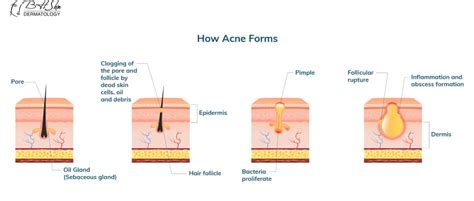 Best Acne Scar Removal Treatments And Products Complete Guide