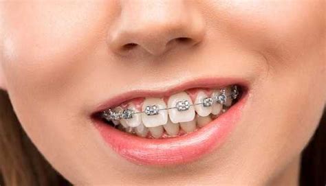 Invisalign treatment is the clear alternative to metal braces for kids, teens, and adults. Difference Between Overjet and Overbite