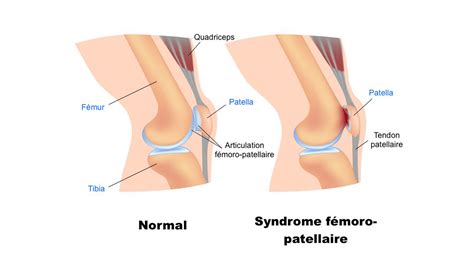 Les principaux problèmes aux genoux Bouge Tes Genoux