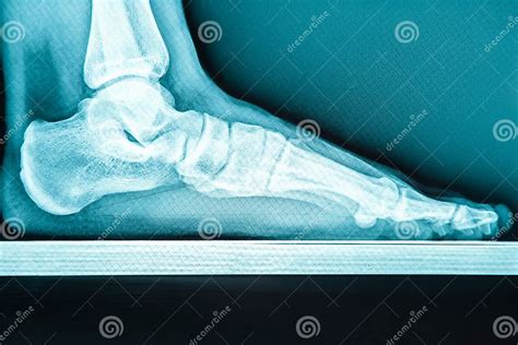 X Ray Human Foot With Flatfoot Stock Image Image Of Lateral Patient