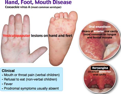 Hand Foot And Mouth