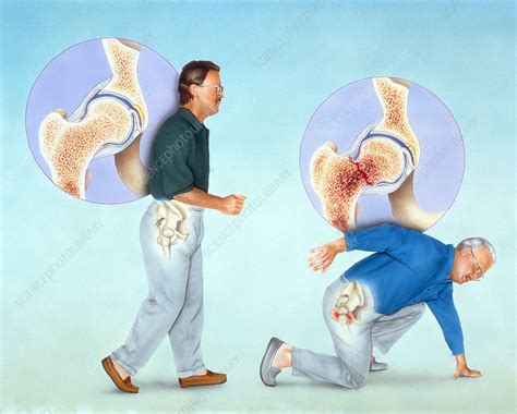 Osteoporosis And Hip Fracture Stock Image C0034995 Science Photo