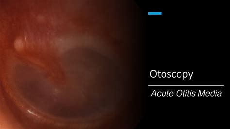 Acute Otitis Media Otoscopy Youtube