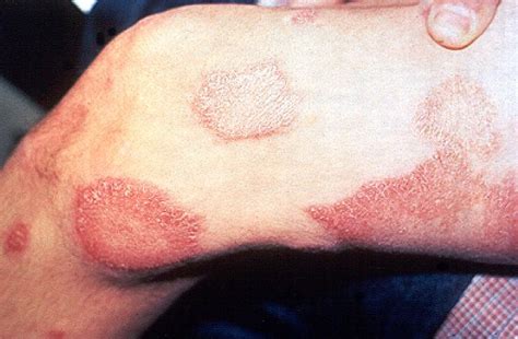 Leprosy Pictures Causes Symptoms Tests Treatment Complications