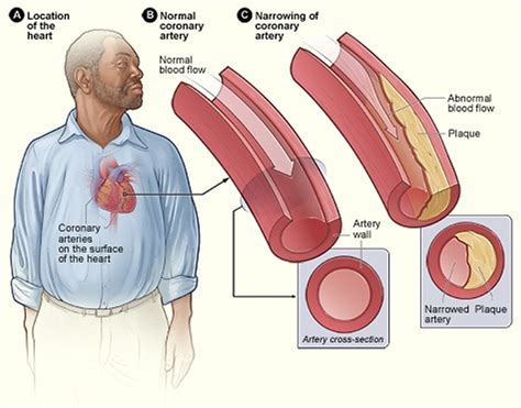 Coronary Heart Disease Causes Symptoms Treatment