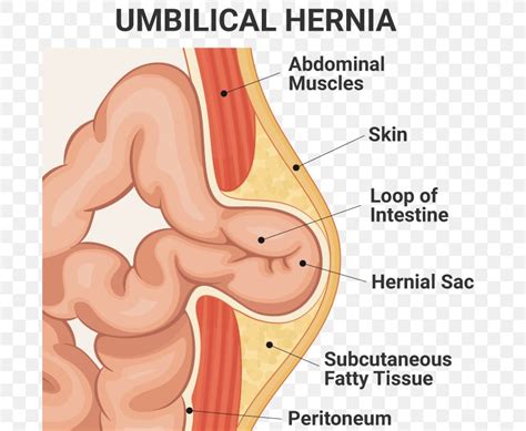 Umbilical Hernia Hernia Repair Inguinal Hernia Surgery Png 688x674px