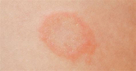Ringworm Causes — Why Do I Keep Getting Ringworm