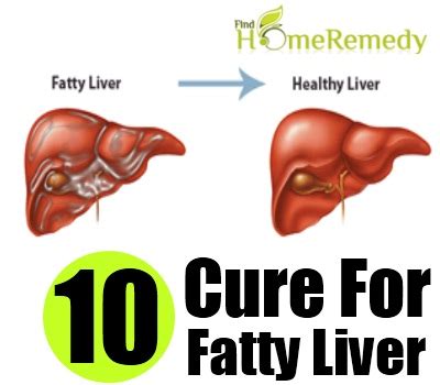 Abdominal swelling, if you are not pregnant, usually. Natural Cure For Fatty Liver - How To Cure Fatty Liver ...