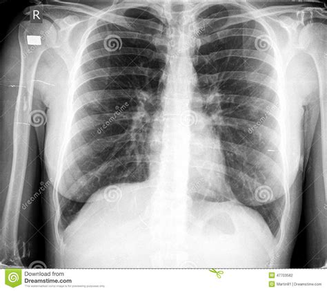 Xray Chest Stock Photo Image Of Bronchitis Exploration