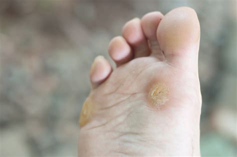 5 Quick Ways To Remove Hard Foot Skin Corns And Calluses Footfiles
