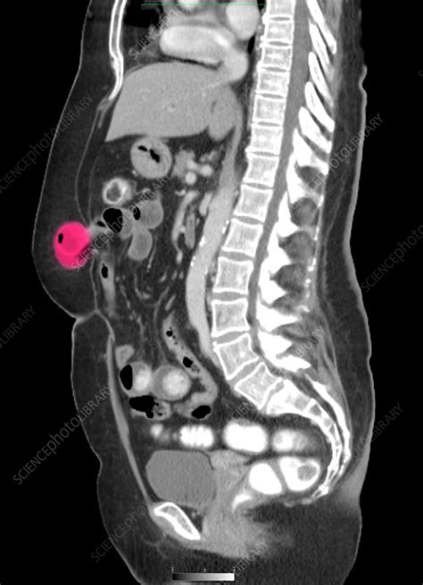 Abdominal Wall Hernia Stock Image C0029977 Science Photo Library