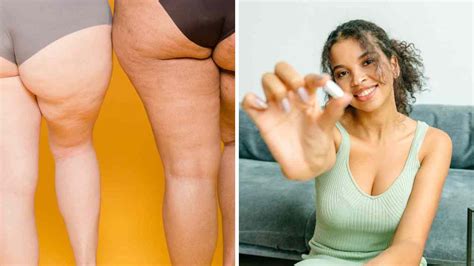 Battling Bum Dimples Does Collagen Help With Cellulite