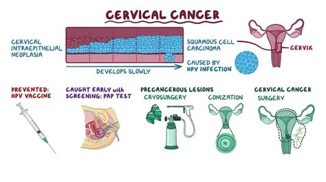 Cervical Cancer Video Anatomy Definition Function Osmosis