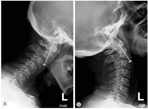Three Months Post Operative X Ray Dynamic Study Of The Cervical Spine