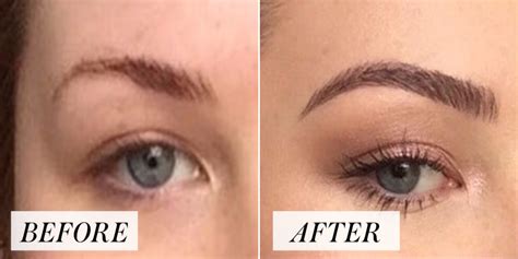 Eyebrow Scars Because Of Microblading Causes And Preventions