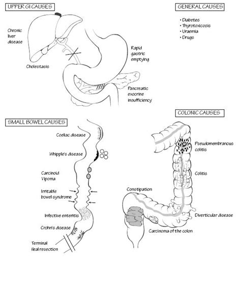 Diarrhea occurs when a person suffers from repeated bowel movements which are loose and watery. Surgery At a Glance: Diarrhoea