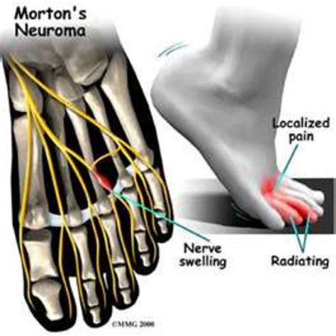 Mortons Neuroma Revised Information And Natural Pain Relief Hubpages