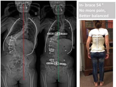 Bracing Adult Scoliosis From Immobilization To Correction Of Adult Scoliosis Intechopen