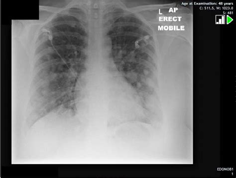 Chest X Ray Displaying Multiple Widespread Pulmonary Nodules