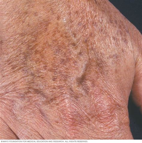 Age Spots Liver Spots Symptoms And Causes Mayo Clinic Liver