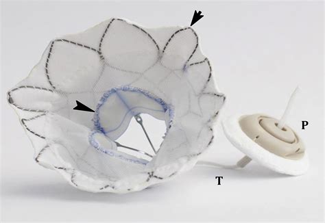 Transcatheter Mitral Valve Replacement With Tendyne Interventional