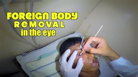 Foreign Body Removal In The Eye Youtube