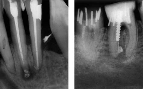 40 Endodontic Surgery Pocket Dentistry