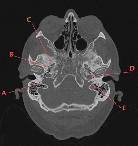 Axial Computed Tomography Of The Skull Base The Bmj