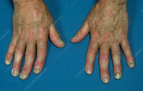 Psoriasis Affecting The Fingers Stock Image M2400010 Science