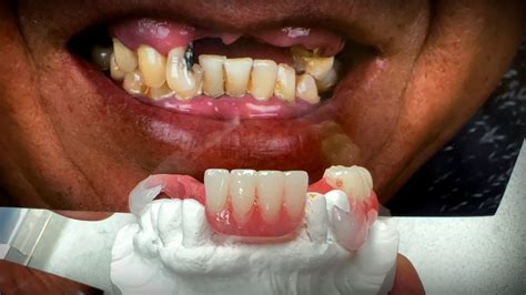 How To Combine A Denture And Flexible Partial For A Stellar Restoration
