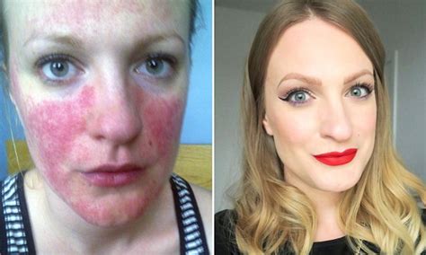 London Woman Suffering From Rosacea Skin Condition Ditches Gluten For A