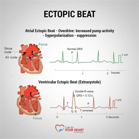 Ectopic Heartbeats Are Small Changes In Be Heart Healthy