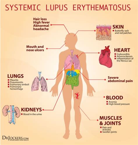 Systemic Lupus Symptoms Causes And Support Strategies In 2020 Lupus