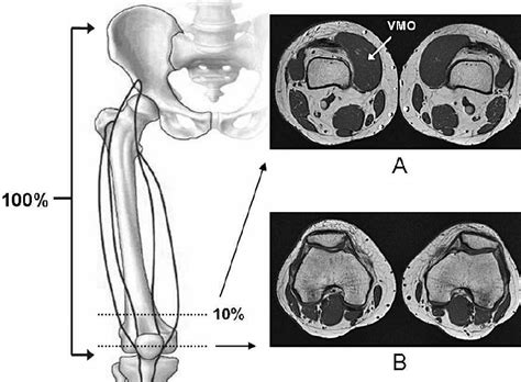 Vmo stands for vastus medialis oblique and is part of the vastus medialis quadriceps muscle at the front of the thigh. Selected axial magnetic resonance images. A, Vastus ...