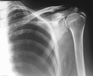 Calcific Tendinopathy Of The Shoulder Physiopedia