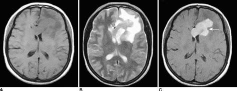 Figure 3 From Mri Findings Of Primary Cns Lymphoma In 26