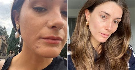 Everything You Need To Know About Spironolactone For Acne Who What Wear
